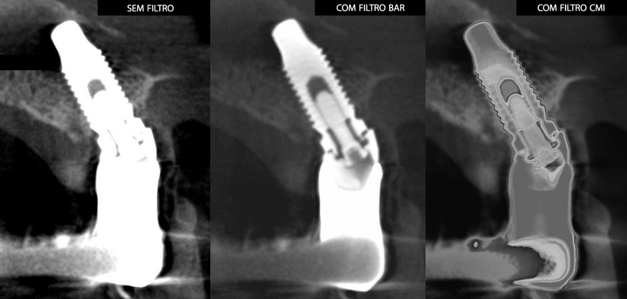 Filtro BAR - Blooming Artifact Reduction