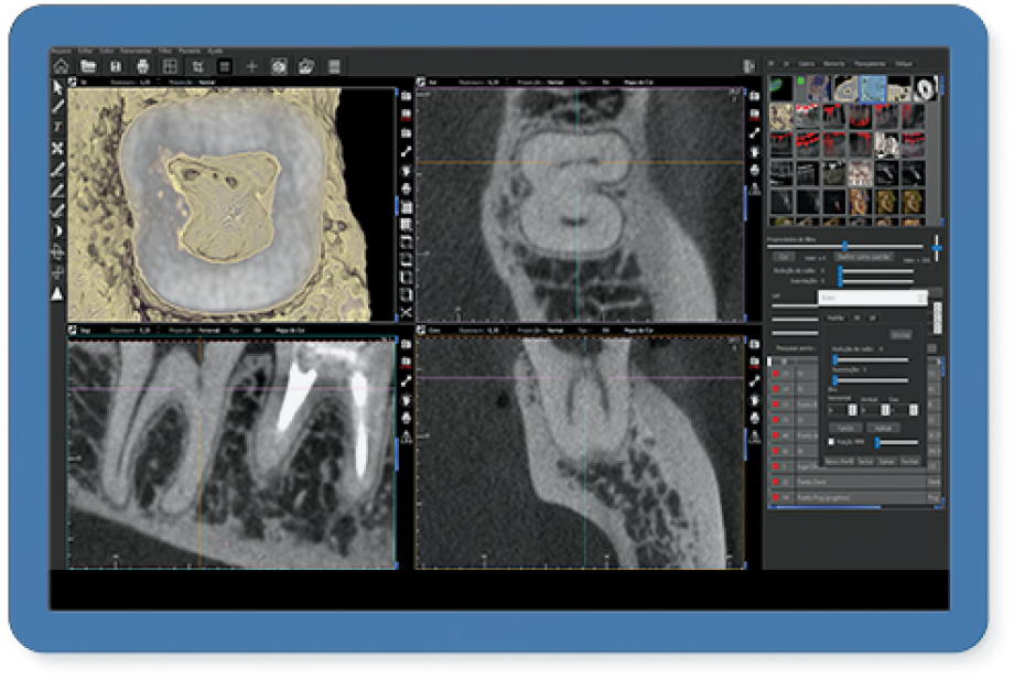 Filtro ACI - Accessory Canal Identification