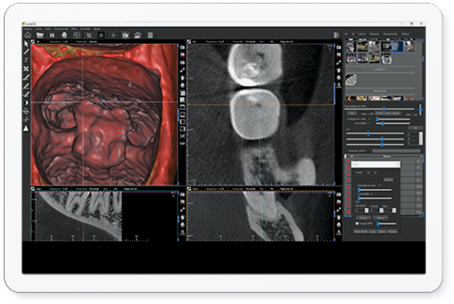 Filtro DP - Dental Pulp
