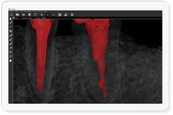 Filtro EF - Endodontic Filling